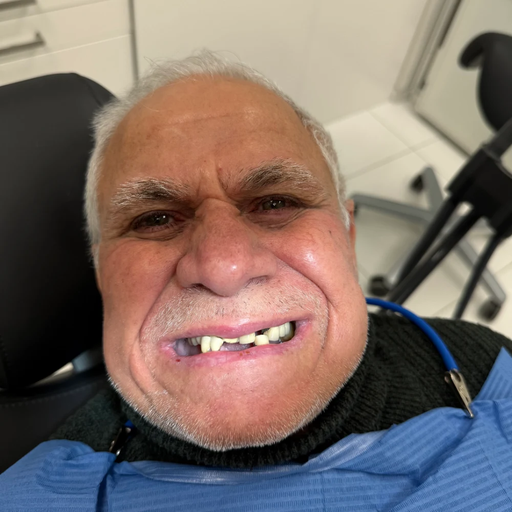 Före implantatbehandling – XDental Norrköping
